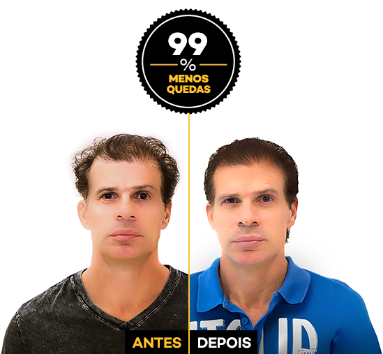 tulio-antes-depois.png Tulio Antes e Depois